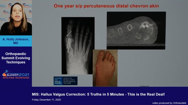 Hallux Valgus Orthobullets | Atelier-yuwa.ciao.jp