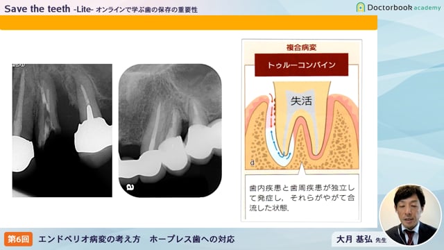 【オンデマンド】Save the teeth−Lite−オンラインで学ぶ歯の保存の重要性 「 第六回：エンドペリオ病変の考え方，ホープレス歯を治すには」