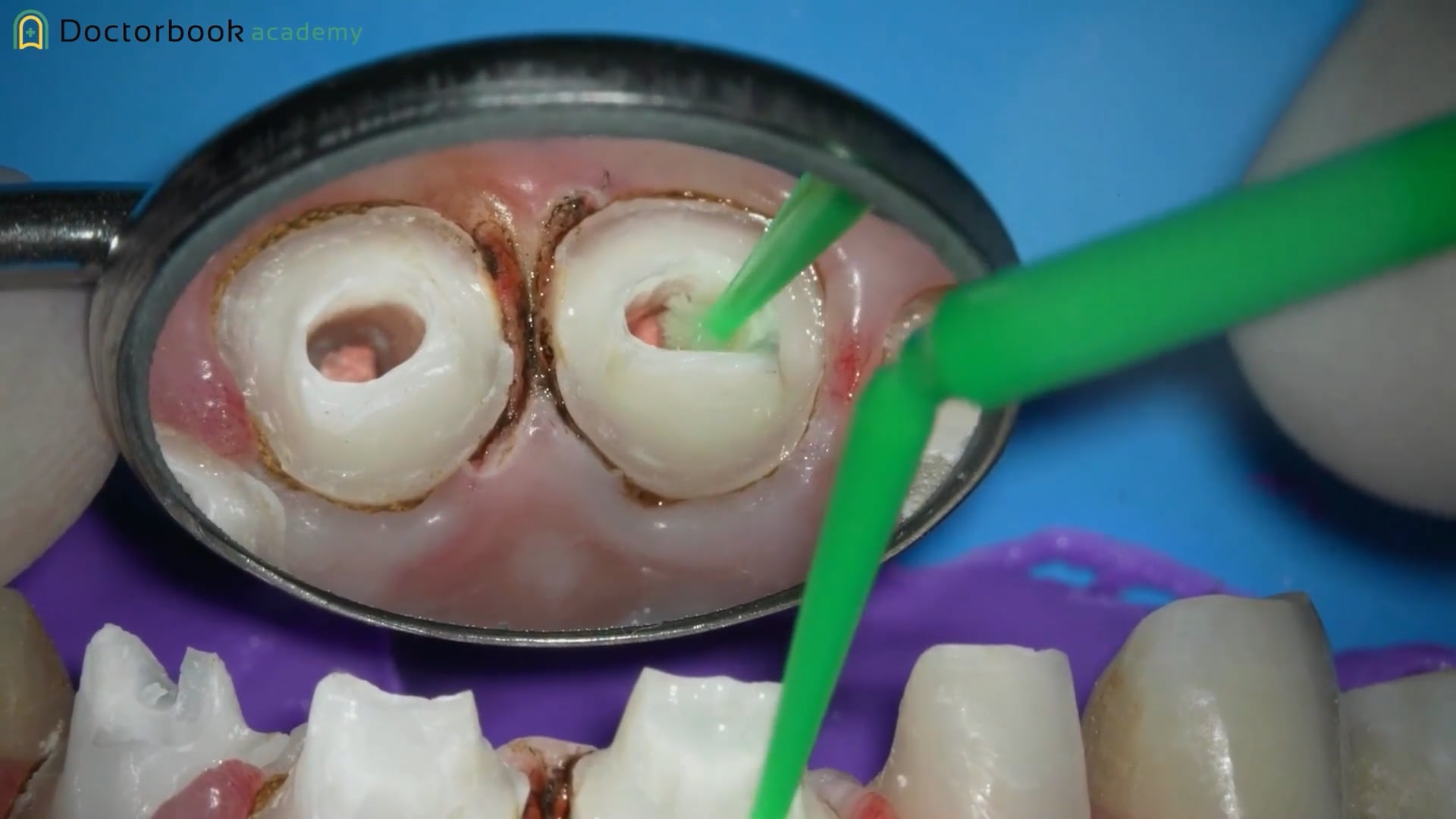 #5 レジンコア、支台歯形成の方法 形成について