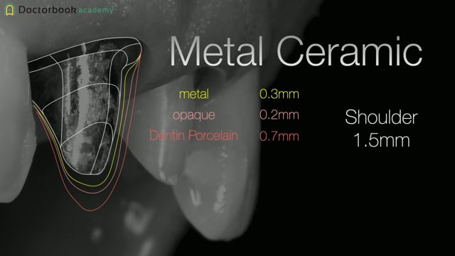 #1 Comprehensive abutment procedure概論　ケースプレゼンテーション(非補綴の歯に対して必要最小限の形成)