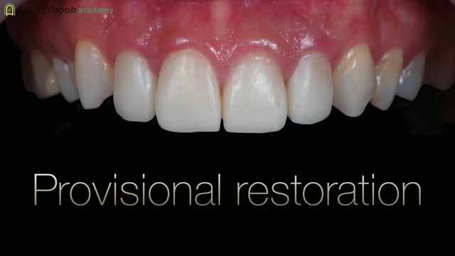 #2 最薄プロビジョナルを可能にしたDigital Dentistry 失活歯に対するアバットメント治療指針 ケースプレゼンテーション(マイクロの重要性について)