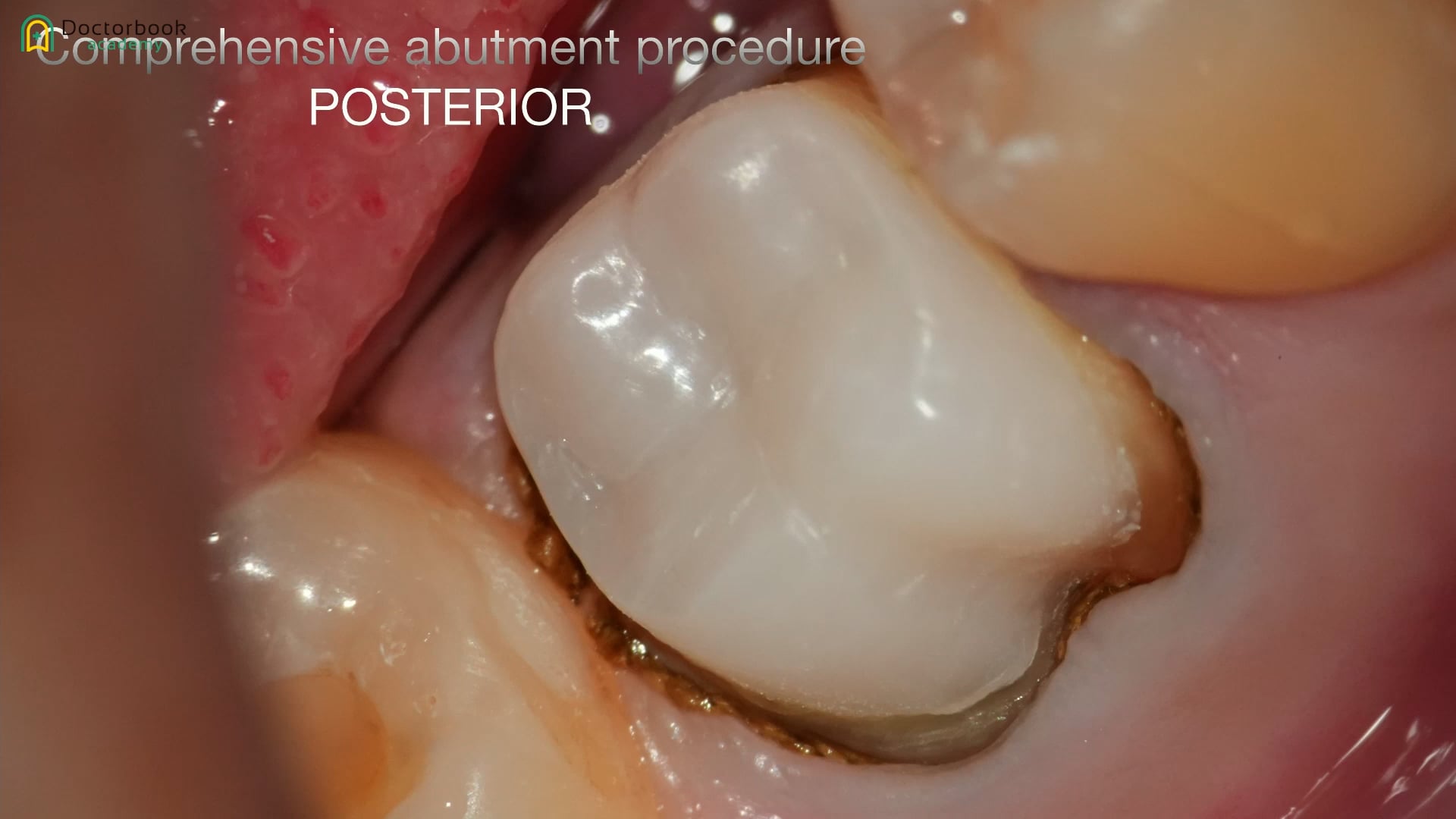 #1 臼歯におけるComprehensive Abutment Procedure