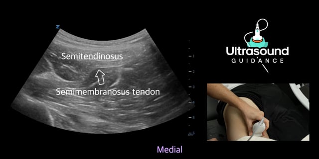 Posterior Hip Scans