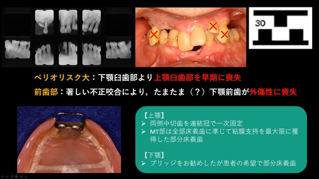 #1 臼歯部咬合支持を効果的に回復するポイント