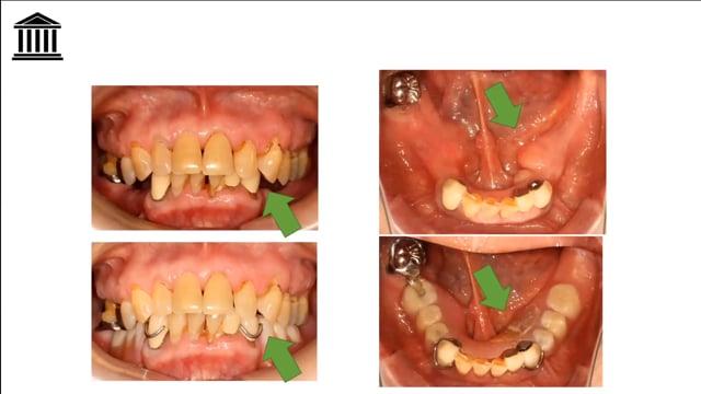 #2 臼歯部咬合と前歯部構造の強化