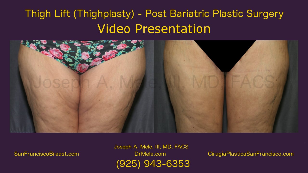 🥇 NYC Thigh Lift (Thighplasty), Manhattan Thigh Plastic Surgery