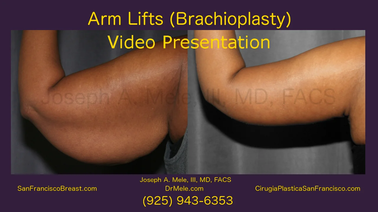 Arm Lift in San Francisco Bay Area Walnut Creek, CA