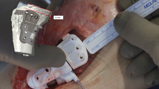 Biplanar HTO for Sagital Malalignment in Revision ACL Reconstruction