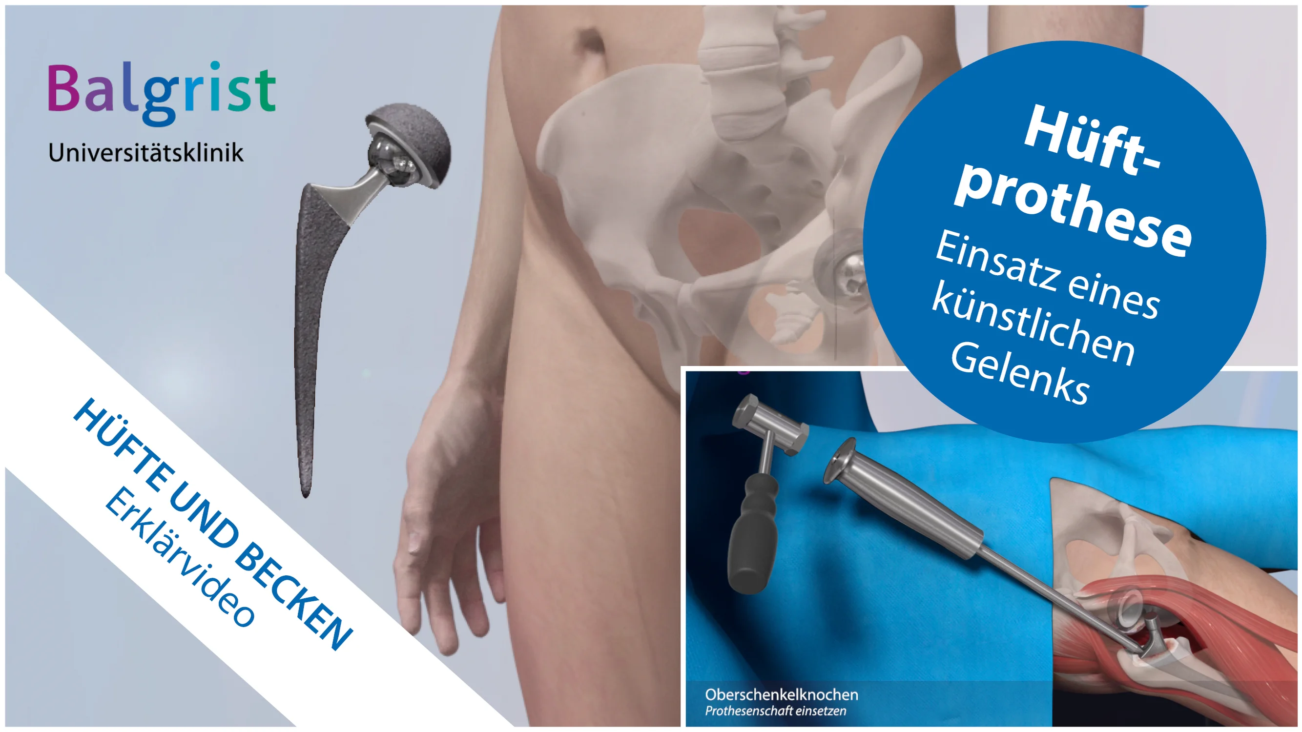 Knstliches Hftgelenk bei Arthrose