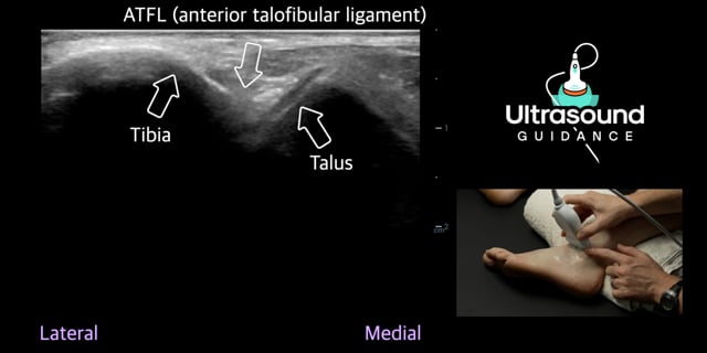 Lateral Ankle Scans