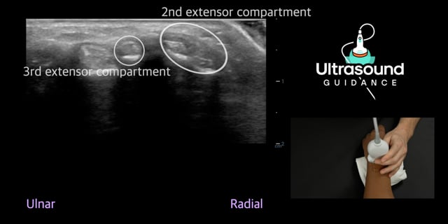 Dorsal Wrist Scans