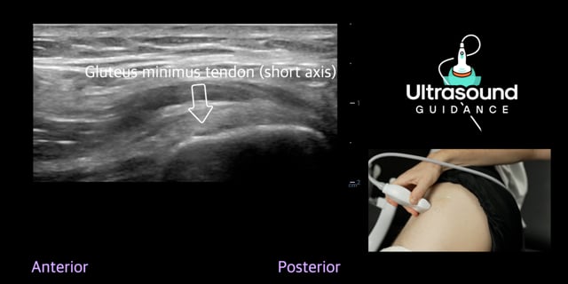 Lateral Hip Scans