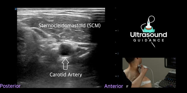 Neck Spasticity Scan