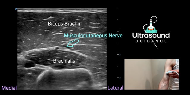 Upper Extremity Spasticity Scan