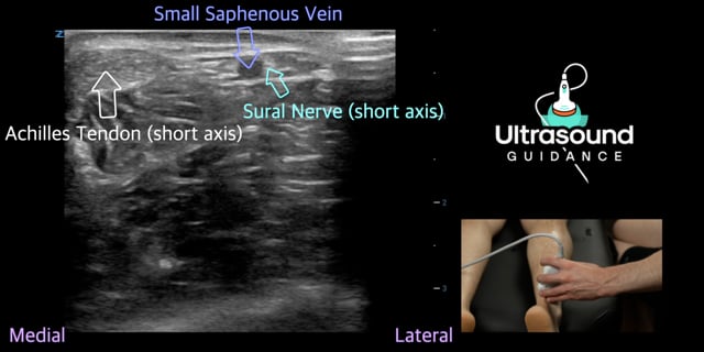 Sural Nerve Scan