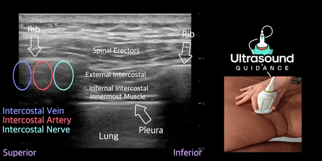 Intercostal Nerve Scan