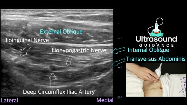 Ilioinguinal and Iliohypogastric Nerves Scan