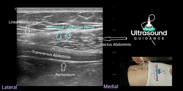 Abdominal Cutaneous Nerves Scan