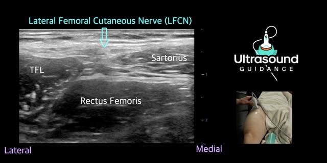 Lateral Femoral Cutaneous Nerve Scan
