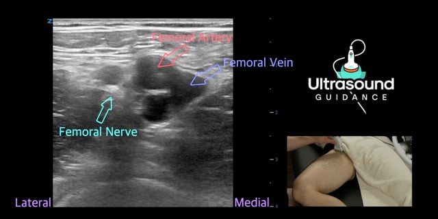 Femoral Nerve Scan