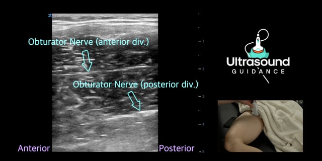 Obturator Nerve Scan