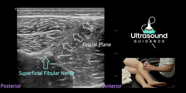 Common Fibular Nerve Scan