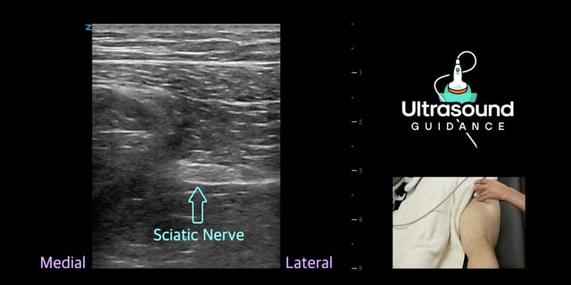 Sciatic Nerve Scan