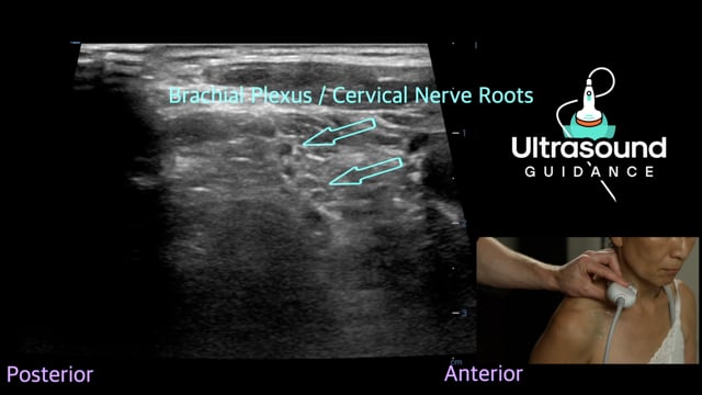 Brachial Plexus Scan