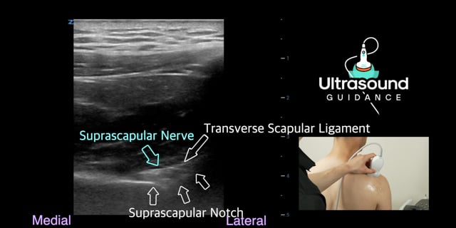 Suprascapular Nerve Scan