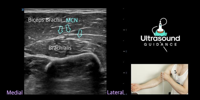 Musculocutaneous Nerve Scan