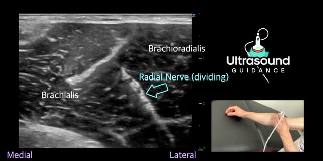 Radial Nerve Scan