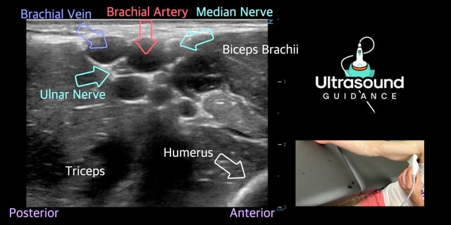 Ulnar Nerve Scan