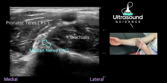 Median Nerve Scan