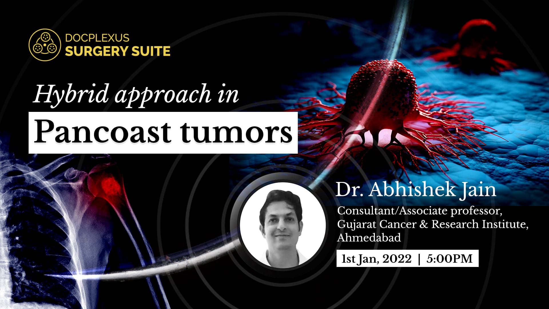 Hybrid approach in Pancoast Tumors