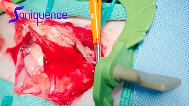 Splenectomy