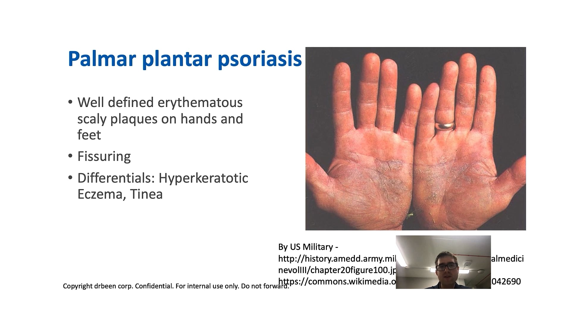 Psoriasis 