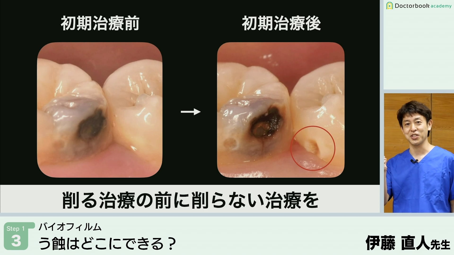 う蝕はどこにできる？│Step1-3