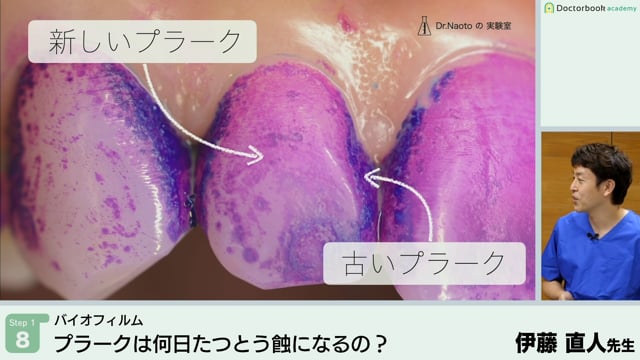 プラークは何日たつとう蝕になるの？│Step1-8