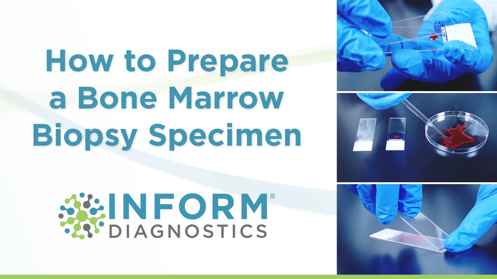 Bone Marrow Core Biopsy Specimen Kit Inform Diagnostics on Vimeo