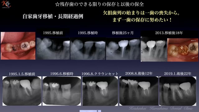 #1 欠損歯列に対しての評価