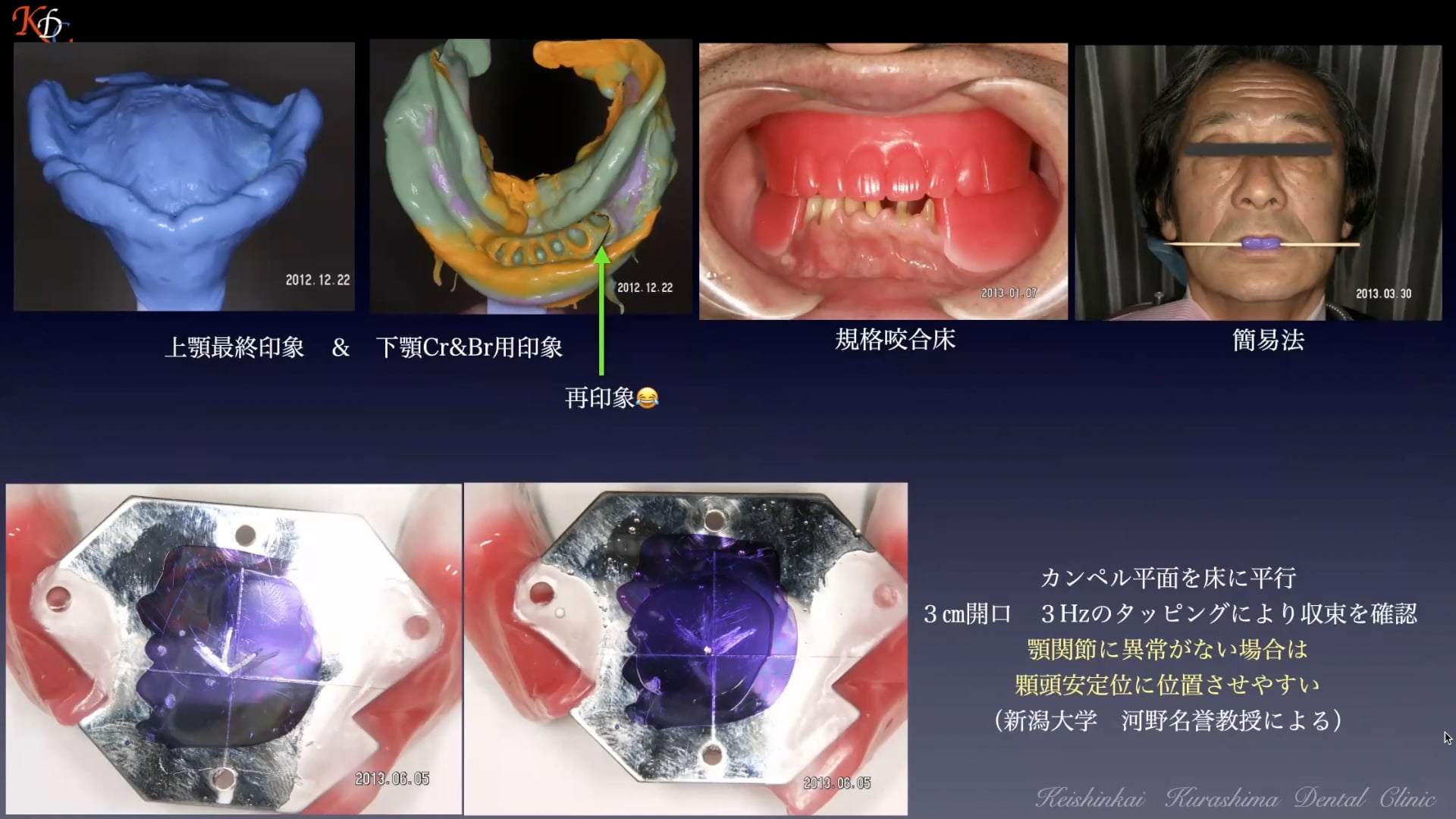 #2 前後的完全すれ違い咬合に熟慮した補綴設計