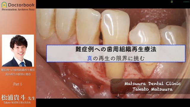 難症例への歯周組織再生療法 真の再生の限界に挑む