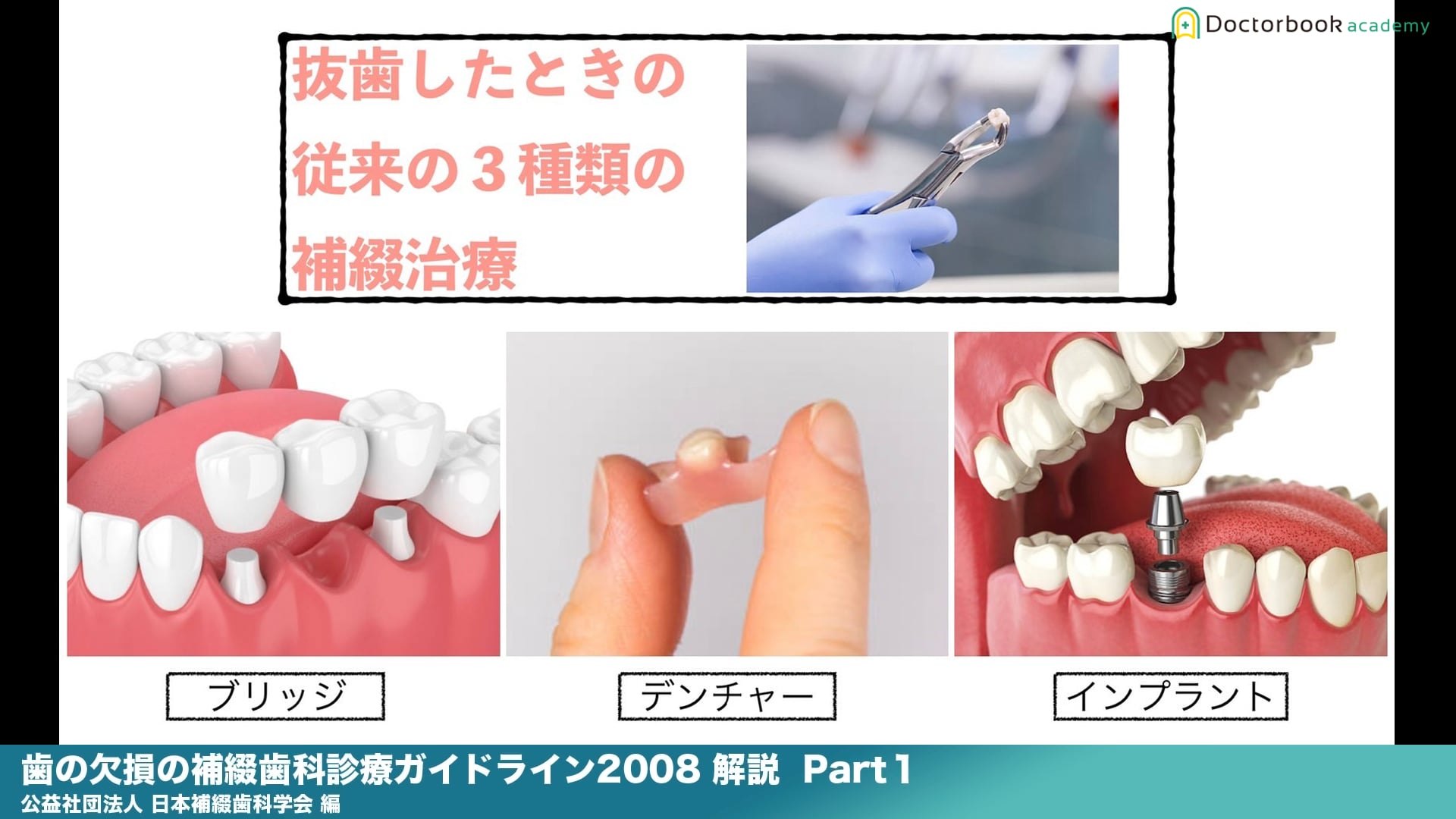 『歯の欠損の補綴歯科診療ガイドライン2008』解説 Part1