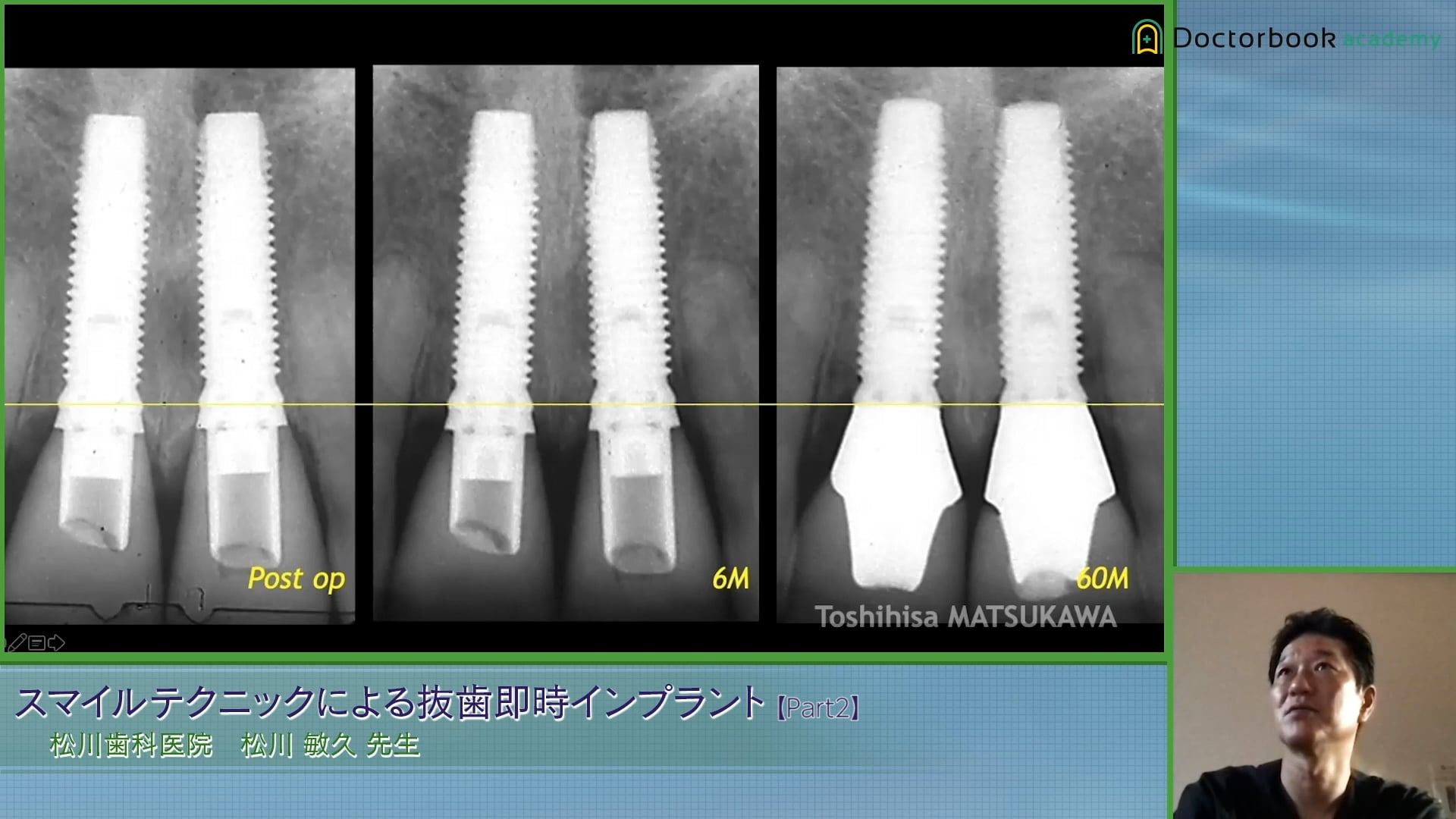 #2 ノーベルスピーディー 症例