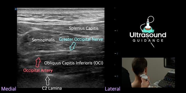 Greater Occipital Nerve Scan