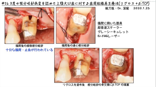 #2 重度欠損症例に対する真の再生