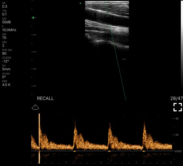 Eagleview™ Pocket Portable Doppler Ultrasound: wireless curvilinear  ultrasound probe for iPad, iPhone and Andriod Phone. – EagleView