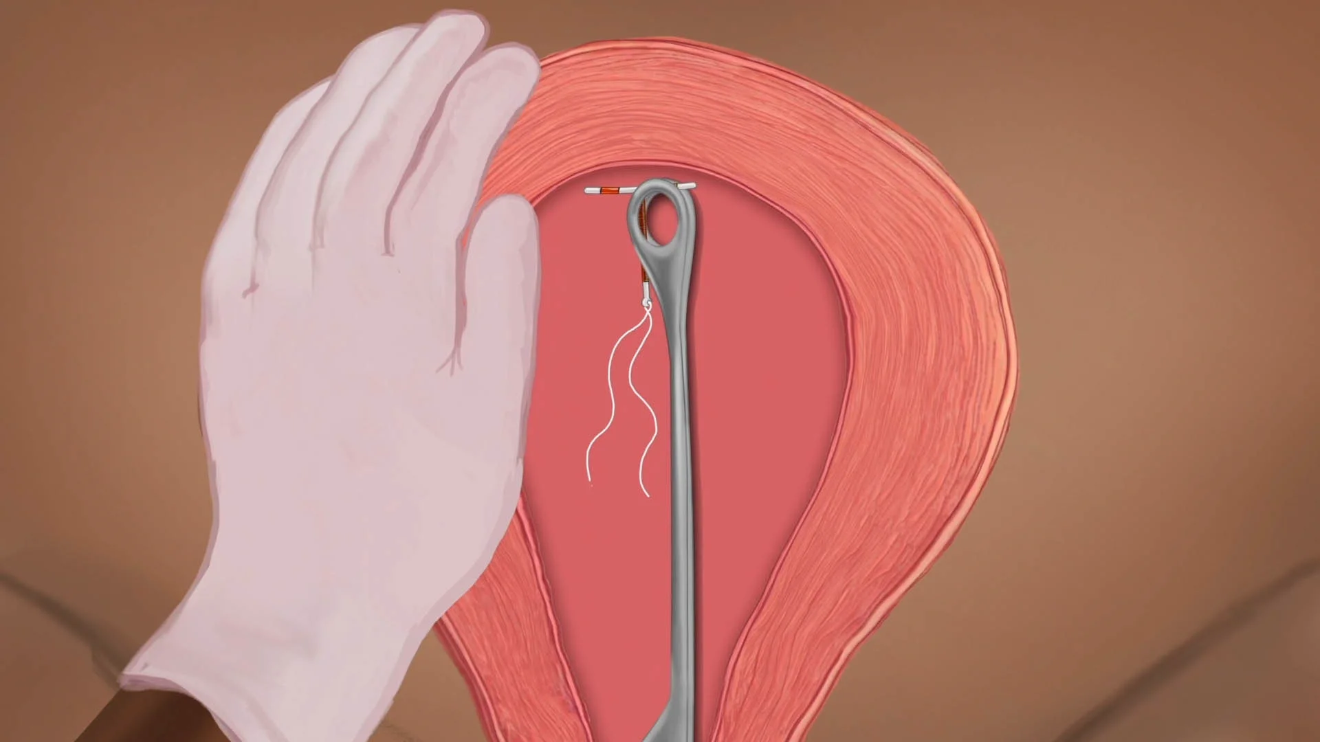 Vaginal IUD video