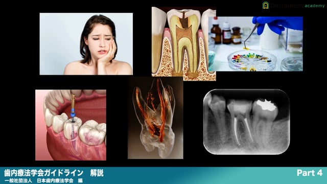 『歯内療法学会ガイドライン』解説 Part4