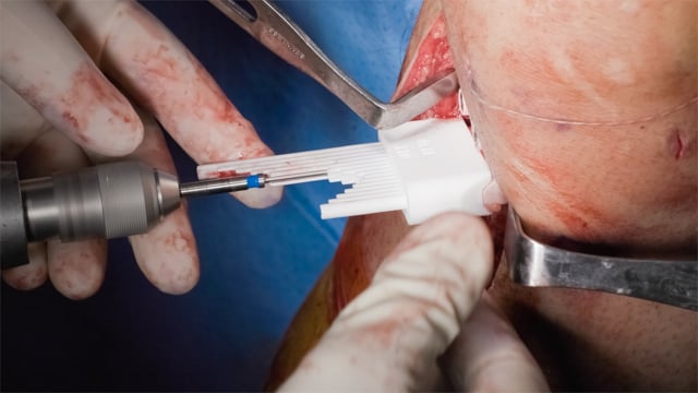 Revision ACL Reconstruction and Biplanar High Tibial Osteotomy with Custom Osteotomy Cutting Jig